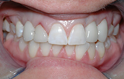 Closeup of smile following implant tooth replacement