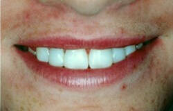 Closeup cosmetic dental bonding