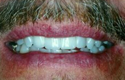 Smile after receiving dental implants in Marlton