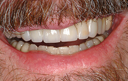 Smile after receiving adult orthodontics in Marlton