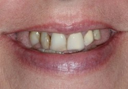 Closeup worn missing and decayed teeth