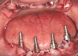 Closeup of four placed implant posts