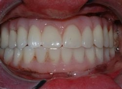 Closeup of teeth with All-on-4 denture