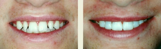 Smile before and after teeth bonding treatment
