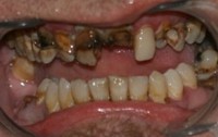 Closeup of smile with missing teeth and decay