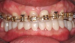 Metal bracket and wire braces on top teeth