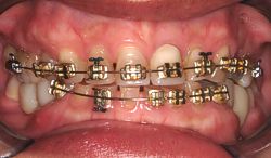 Bracket and wire braces on whole smile