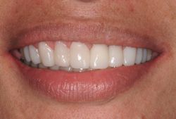 Beautiful smile following orthodontic treatment