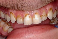 Closeup of teeth with staining yellow near gums