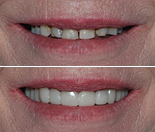 An actual case of a patient who received Snap-On Smile with the help of Dr. Petulla in Marlton
